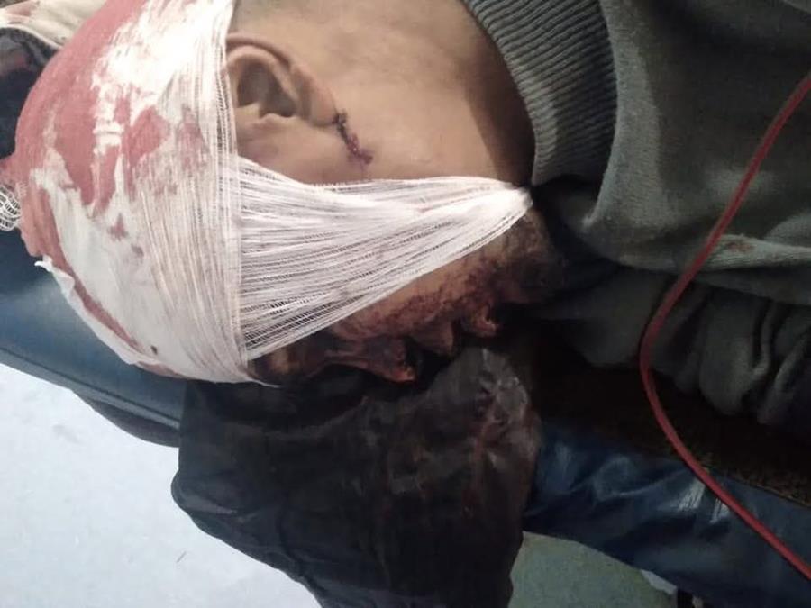 فاس.. ضحية يطالب الجهات الأمنية المعنية إلقاء القبض على شخص تسبب له في عاهة مستديمة
